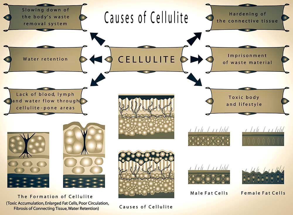 Oorzaken van cellulitis Oorzaken van cellulitis